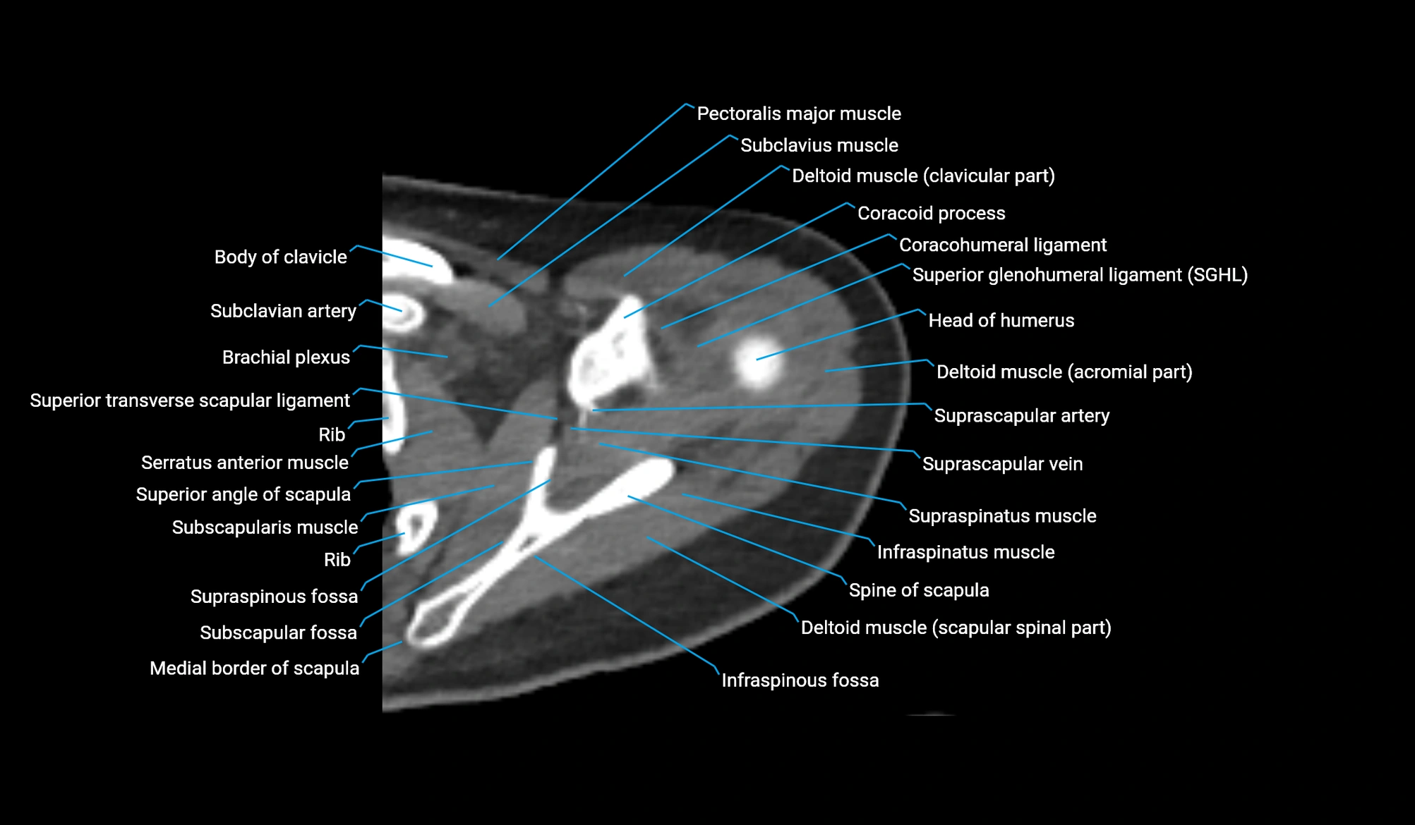CT upper arm axial  cross sectional anatomy labelled radiology image -00076.webp